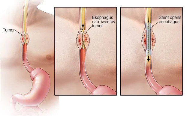 Esophageal Stent | Dr. Sanjay Agrawal