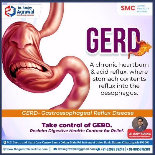 Understanding and Managing GERD (Gastroesophageal Reflux Disease)|Dr Sanajy Agrawal